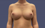 Breast Augmentation 3 After